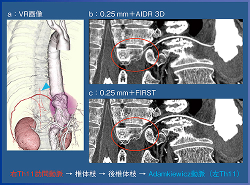 図5　症例2：Crawford Ⅳ型大動脈瘤における側副血行路の連続性の証明