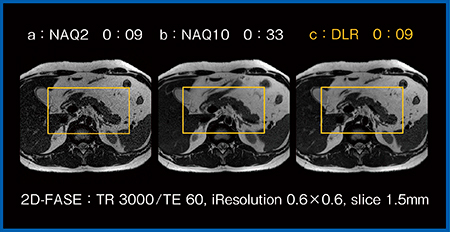 図1　加算回数の異なる2D-FASE T2WIとDLRの比較