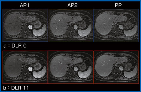 図3　Gd-EOB-DTPA造影ダイナミックMRIにおけるDLRによる描出能の向上（HCC）