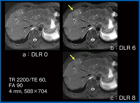 図4　DLRの強度による描出能の変化（多発肝転移）