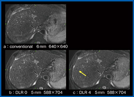 図5　T2低信号結節におけるDLRの影響の検討