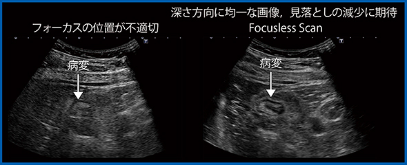 図2　クローン病のFocusless Scan（W.I.P.）