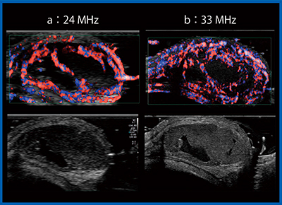 図5　33MHz超・超高周波プローブによる霰粒腫の描出 a：24MHz　b：33MHz