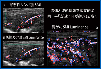 図8　胃悪性リンパ腫と胃がんのDoppler Luminanceの比較 a：胃悪性リンパ腫　b：胃がん