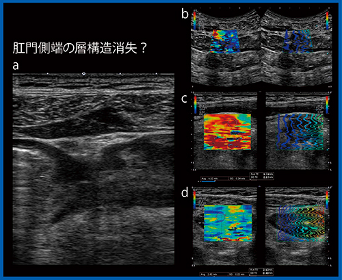 図10　閉塞性大腸炎の7MHzプローブによるSWE（W.I.P.） a：Bモード画像　b：4MHz SWE c：がん（6.24m/s）　d：炎症（2.63m/s）