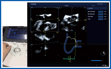 図2　大動脈弁解析ソフトウエアAortic Valve Analysis