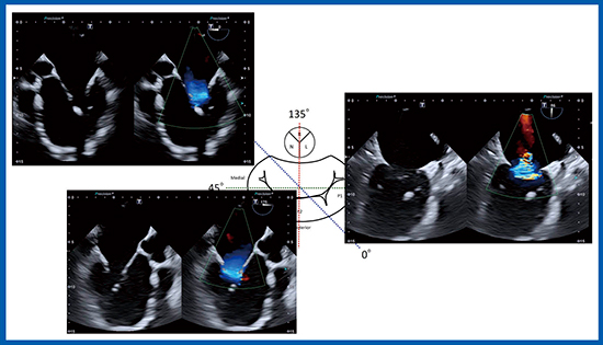 図3　MitraClip治療カンファレンスにおける2D TEEの提示