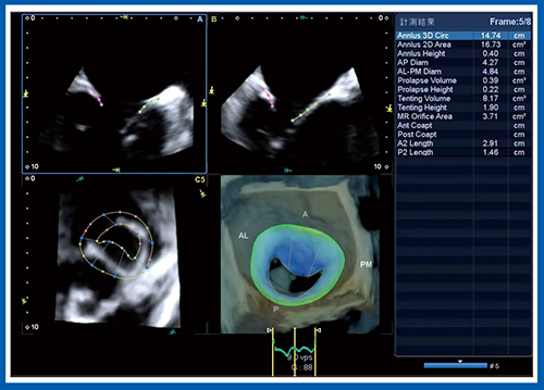 図4　僧帽弁解析ソフトウエアMitral Valve Analysis