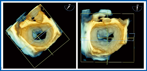 図5　術中TEE：true bi-commissure viewの設定
