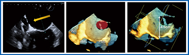 図7　術中TEE：当院における2Dと3Dによる中隔穿刺部位の確認（W.I.P.）