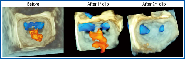図10　クリップ留置前後の3Dカラードプラ