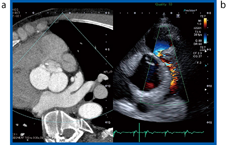 図1　症例1：Valvular PS
