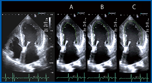 図2　適切な心内膜トレースラインはどれか