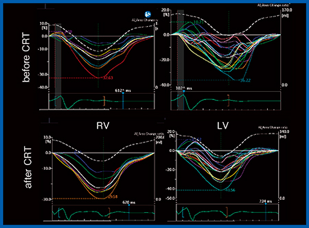 図7　症例2：Quad Chamber Tracking（CRT前後の比較）