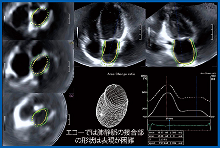 図9　左房の3D WMT