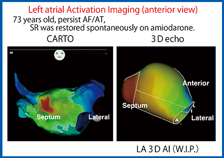 図10　図9の症例のCARTO mappingとActivation Imaging