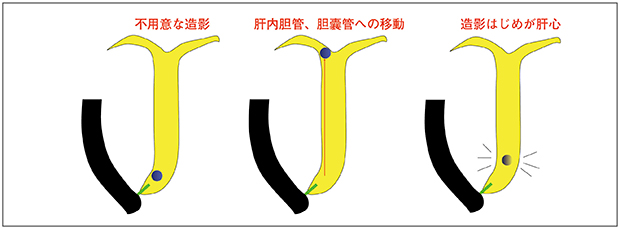 図3　小結石では緩徐な造影を心がける