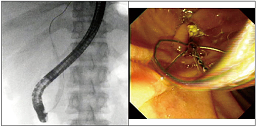 図4　小結石に伴う胆石性膵炎の緊急ERCP