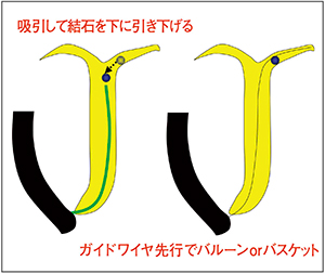 図6　左肝内胆管に迷入した結石への対応