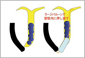 図10　下部胆管の結石への対応