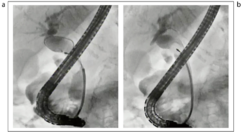 図12　ガイドワイヤルート変更＋バスケット操作による結石除去 a：バスケットが結石の横をすり抜けている b：ルート変更して、再度ガイドワイヤが結石の脇を通るように挿入した