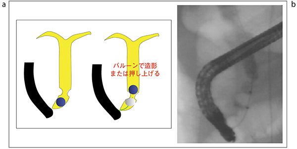 図13　下部胆管ポケットの結石への対応 a：バルーンや造影剤で結石を押し上げる b：バルーン操作で結石を押し上げる