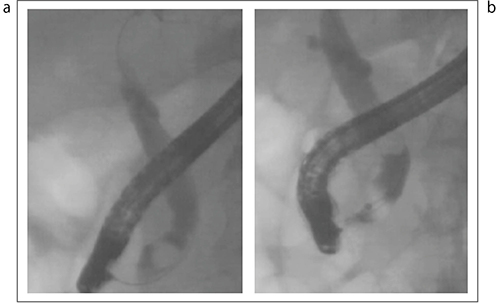 図14　造影剤注入による結石の押し上げ a：下部胆管ポケットに結石が入っている b：造影剤注入により結石を押し上げる