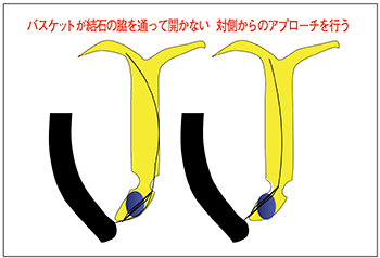 図15　下部胆管のポケット部分の結石がバスケットで把持できない場合