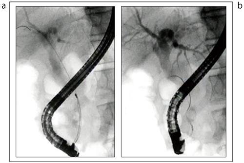 図16　下部胆管ポケットの結石に対するガイドワイヤルート変更例 a：ガイドワイヤを挿入するが、バスケットが開かない b：ガイドワイヤを外した後、再度対側に挿入した