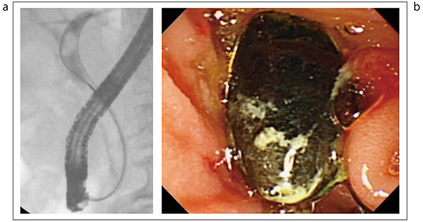 図18　ガイドワイヤ誘導式バスケットによる結石嵌頓予防 a：ガイドワイヤを奥まで挿入　b：結石が排出された