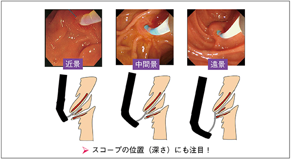 図2　乳頭との距離