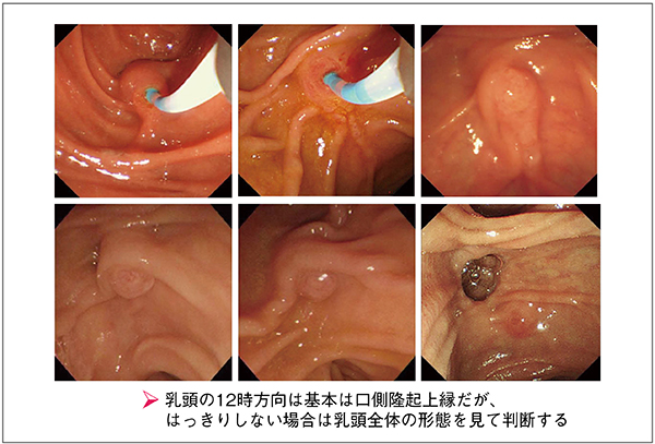 図4　胆管挿管の角度の判断の基準