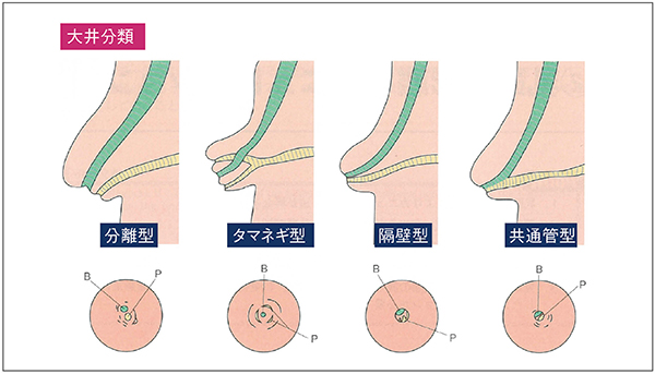 図6　膵管・胆管合流形態の分類（大井分類） （参考文献2）より転載）