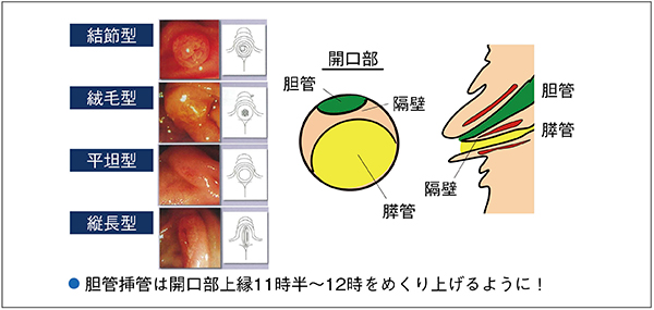 図8　隔壁型における胆管挿管