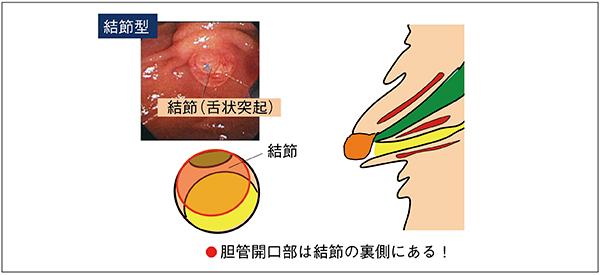 図9　結節型における胆管挿管