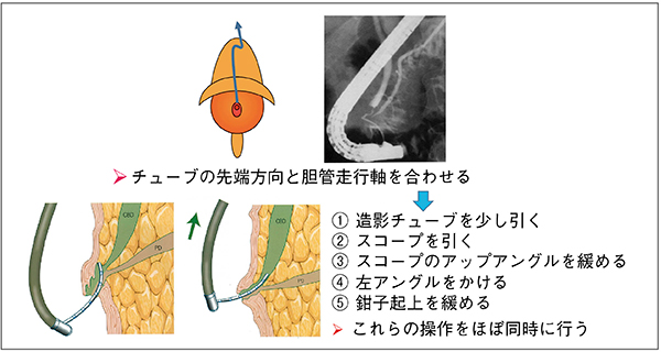 図10　胆管走行軸にチューブの先端方向を合わせる