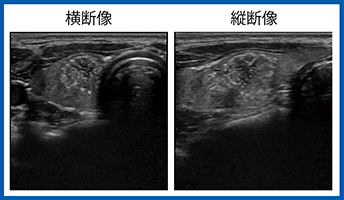 図1　症例1：甲状腺右葉の結節