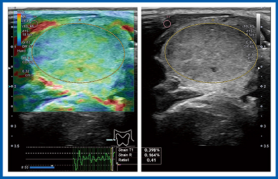 図4　症例2のStrain Elastography