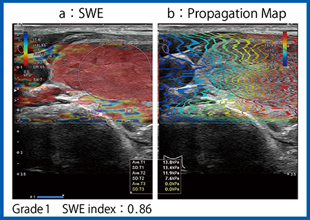 図5　症例2のSWEとPropagation Map