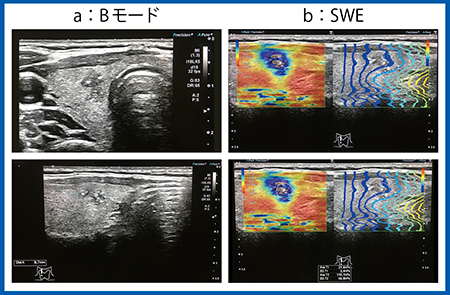 図6　症例3：甲状腺乳頭癌