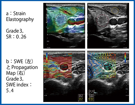 図8　症例4：甲状腺乳頭癌のStrain ElastographyとSWE