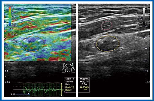 図10　症例5（22歳，女性）：甲状腺乳頭癌症例のリンパ節のStrain Elastography