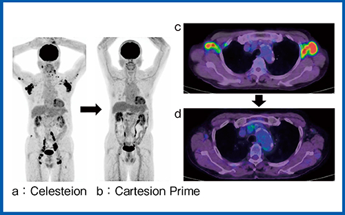 図4　Cartesion Primeによる治療効果判定 （症例3：悪性リンパ腫）