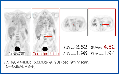 図5　Cartesion Primeによる小集積の定量性向上 （症例4：肺がん骨転移）