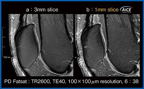 図1　Thin slice画像へのAiCE適用の効果