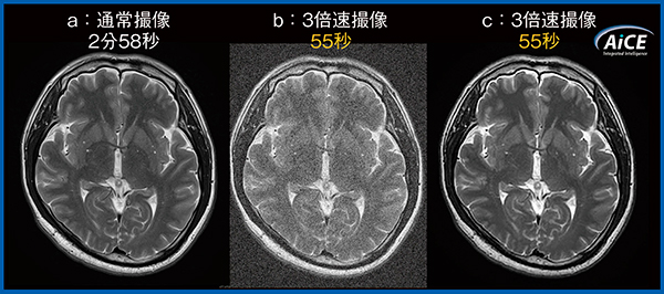 図3　1.5T装置における通常撮像（a），3倍速撮像（b），AiCE付加3倍速撮像（c）の画像比較