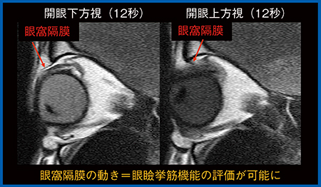 図6　AiCE付加超高速撮像による眼瞼挙筋機能評価