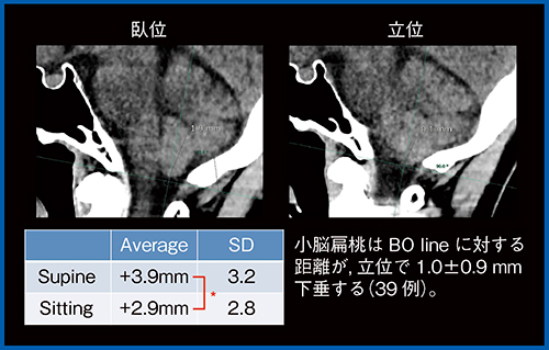図3　小脳扁桃の変位 立位では約1mm程度，下垂していることがわかる。