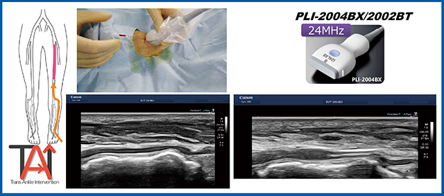 図1　足背動脈穿刺 24MHzプローブを用いることで足背動脈が明瞭に観察できる。
