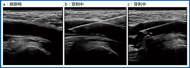 図4　超音波ガイド下穿刺